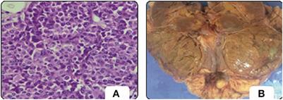 A two-stage renal disease classification based on transfer learning with hyperparameters optimization